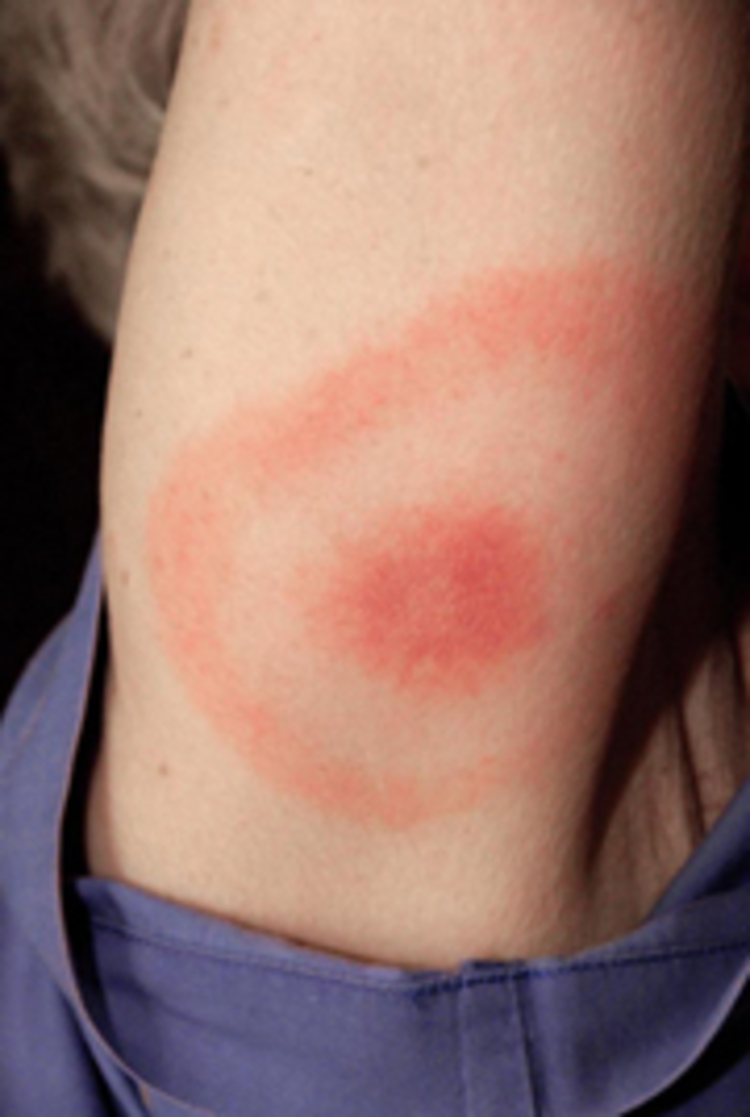 "Target" lesion on patient with Lyme disease. (Courtesy of CDC)</p>  