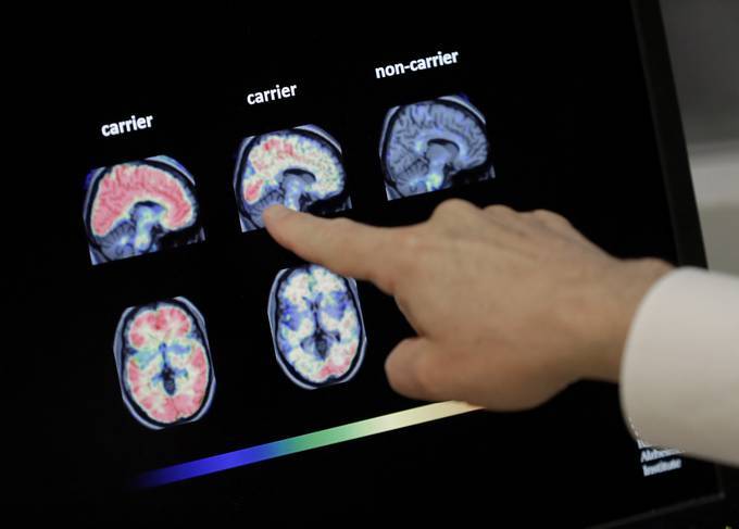 A doctor goes over a PET brain scan at Banner Alzheimers Institute in Phoenix. (Matt York/AP)